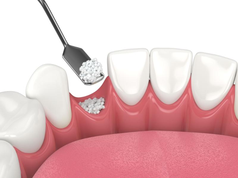 How To Speed Up Bone Graft Healing Process
