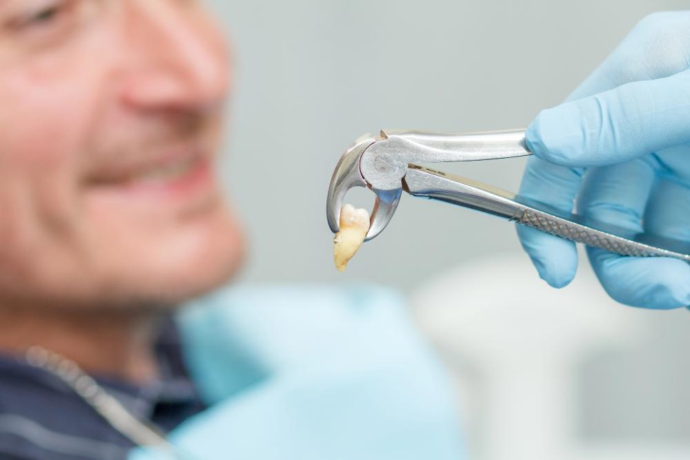 How To Stop Bleeding After Wisdom Tooth Extraction