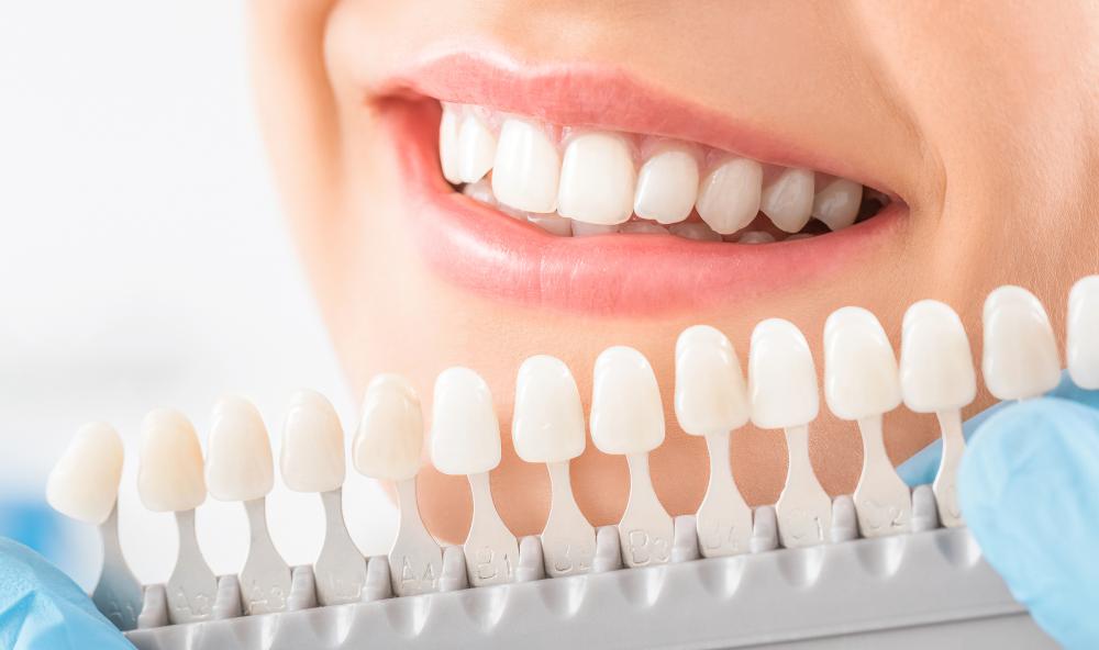 How To Whiten Veneers In 5 Easy Steps