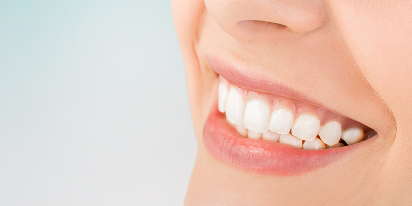 Porcelain Veneers