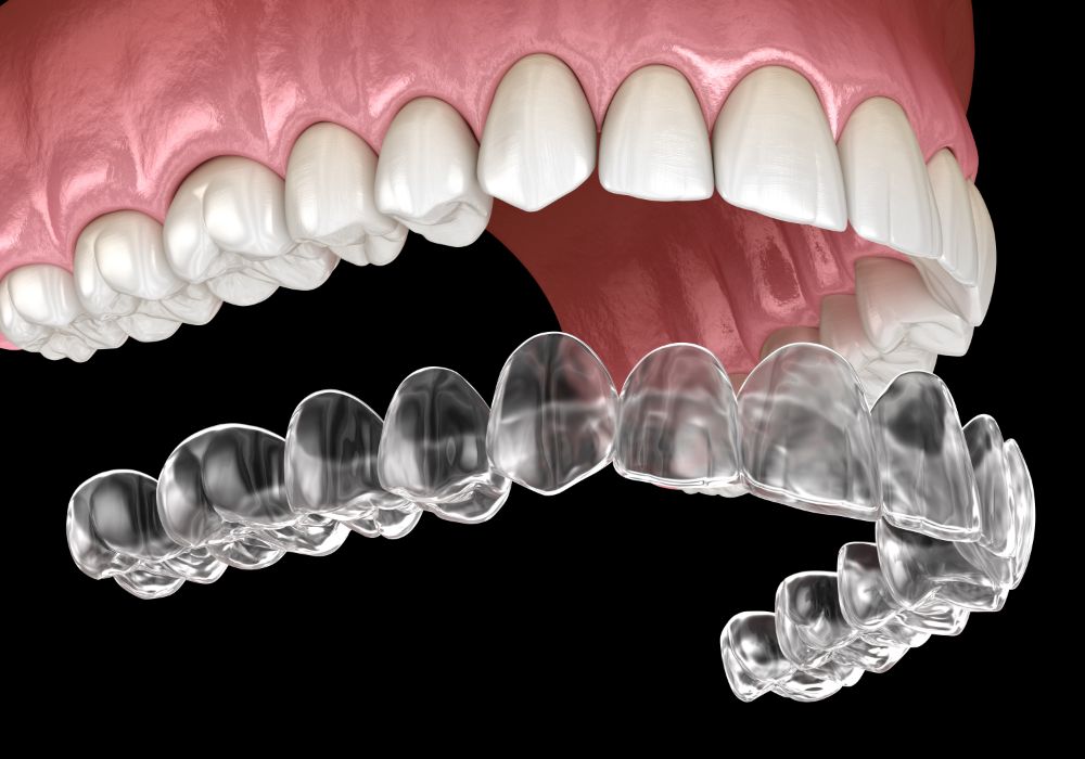 Invisalign Maintenance Best Practices