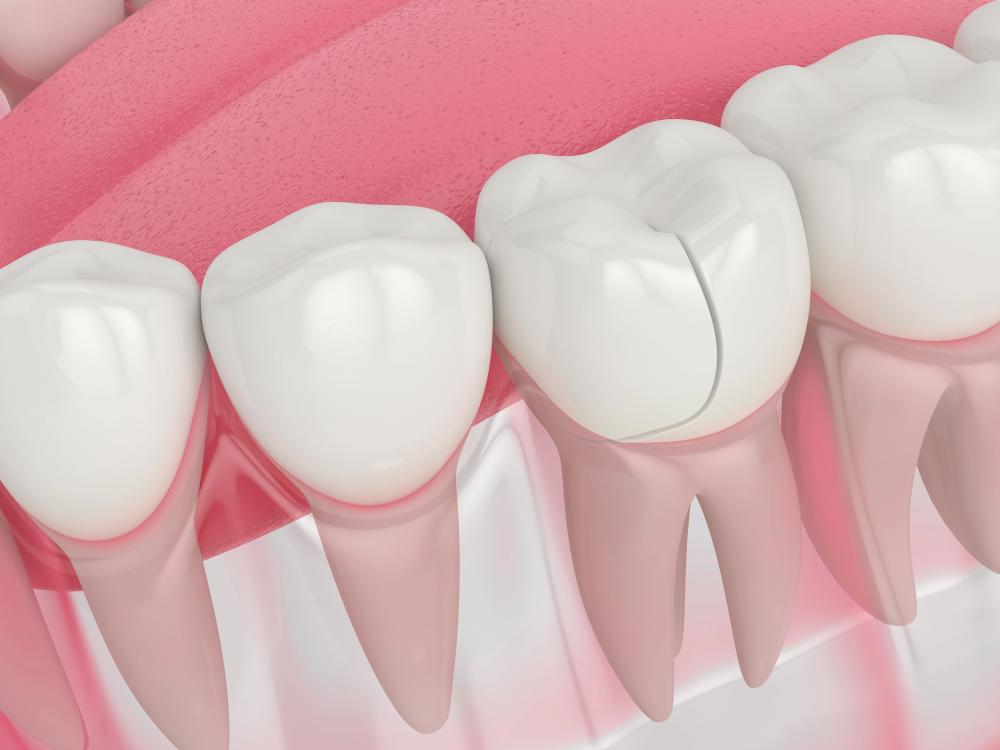 Is A Broken Molar Tooth An Emergency Or Just A Minor Issue?