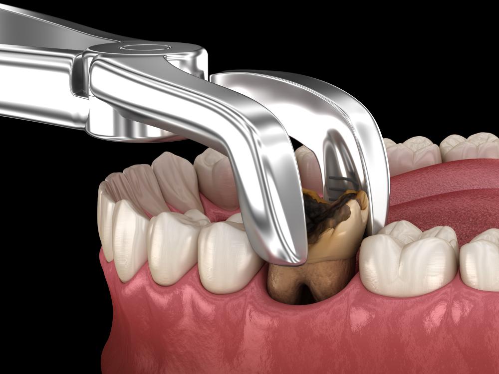 Is Extracting A Broken Tooth The Right Choice For You?