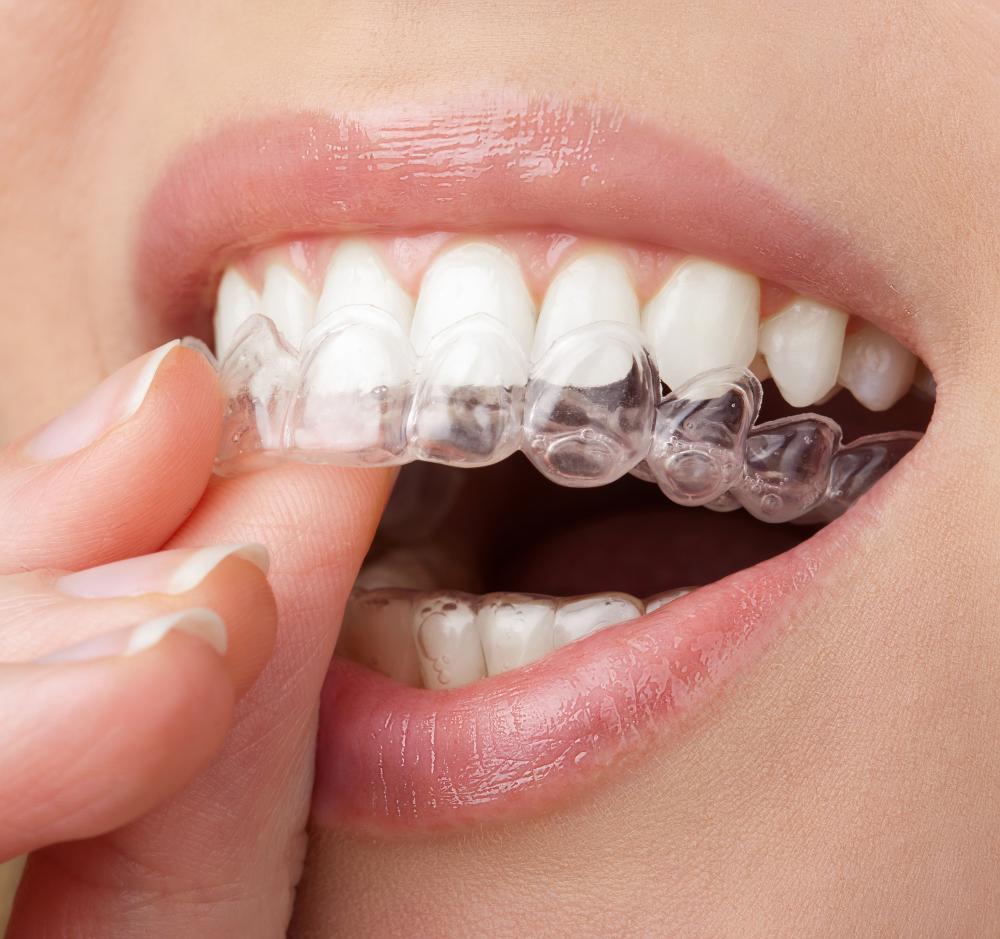 Invisalign