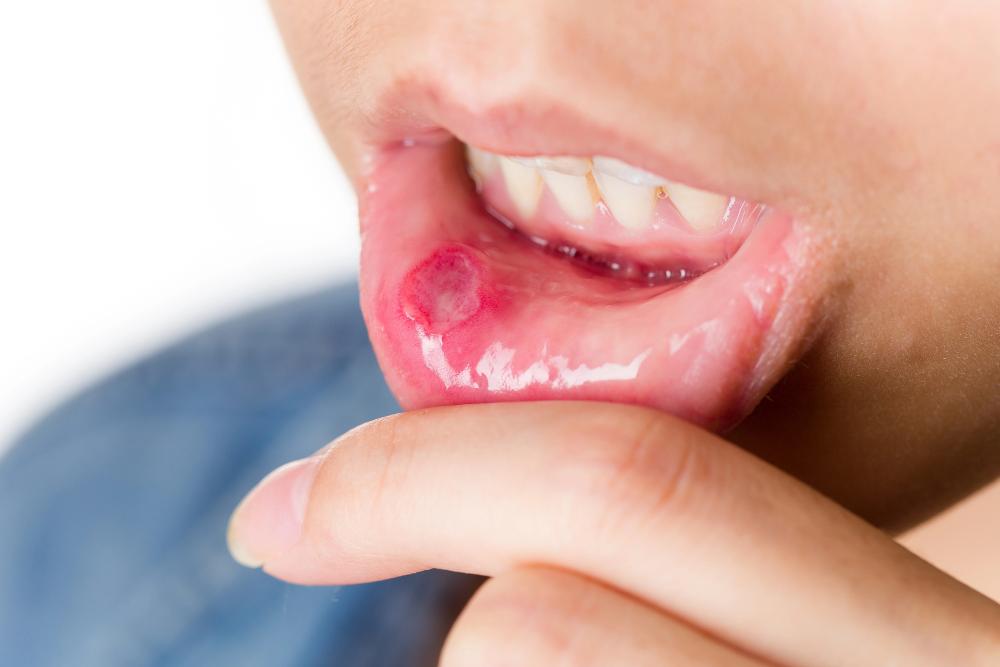 Is It Normal To Get A Canker Sore After Tooth Extraction?