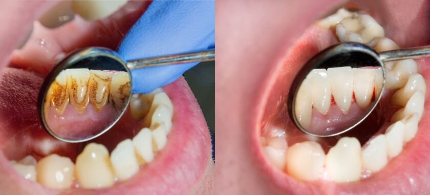 Is Periodontal Disease Prevention Possible?