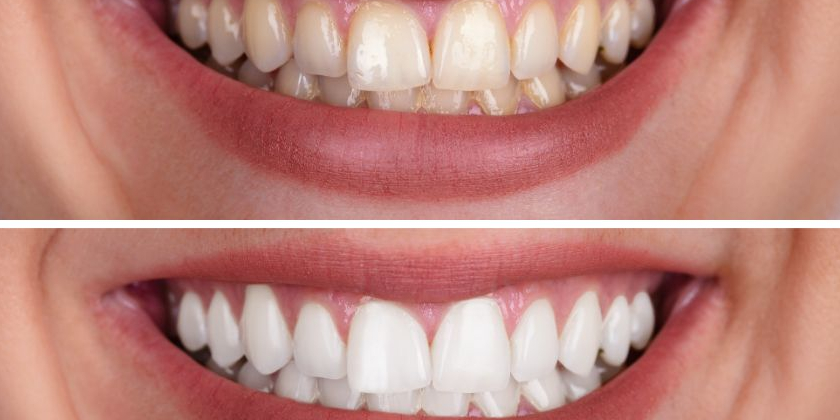 Is Professional Teeth Whitening The Right Option For You?