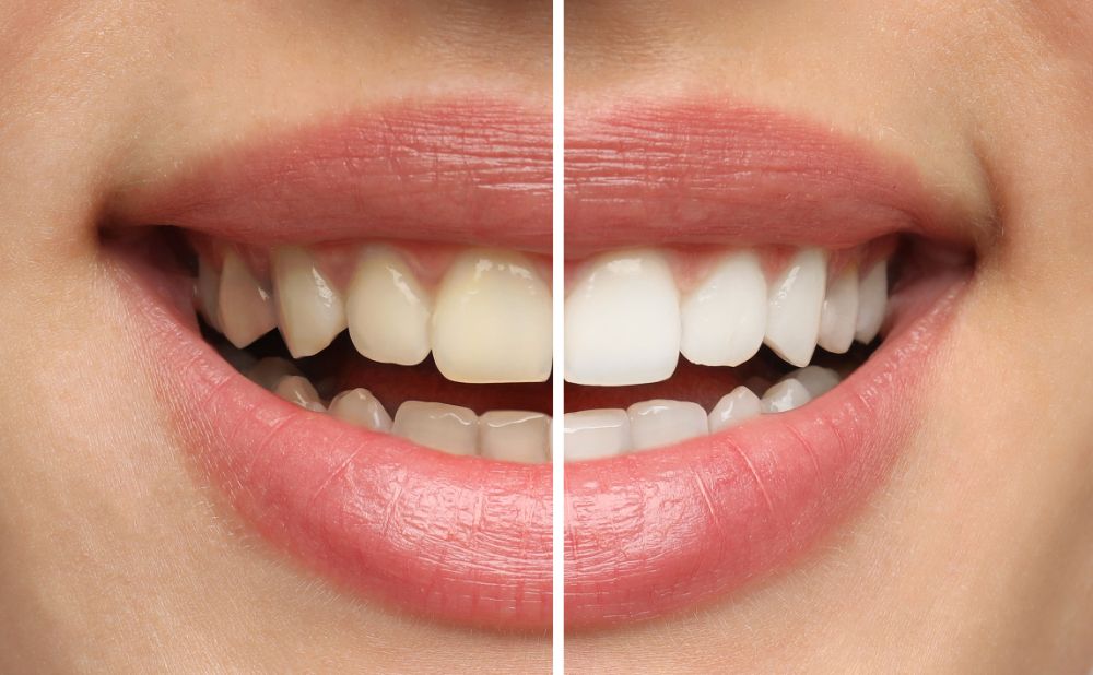 Is There Minimum Age For Teeth Whitening?