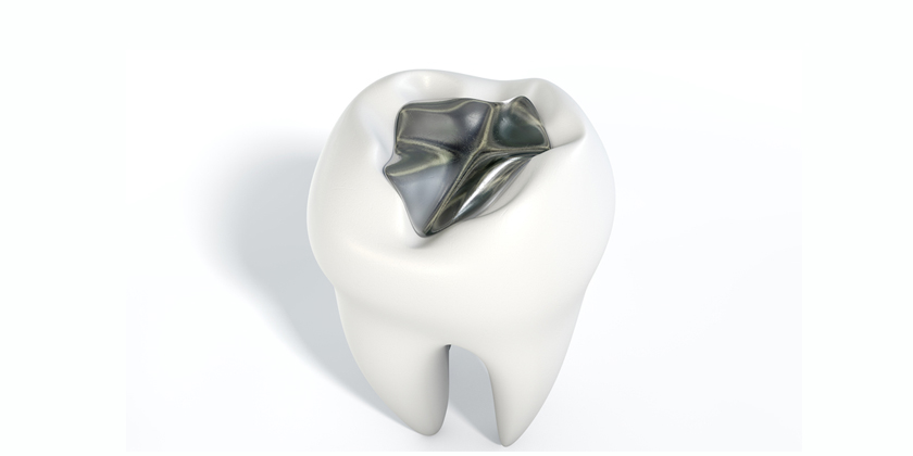 Learn How To Protect Your Dental Fillings