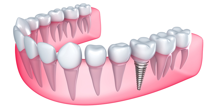 Managing Your Expectations For Dental Bone Grafting