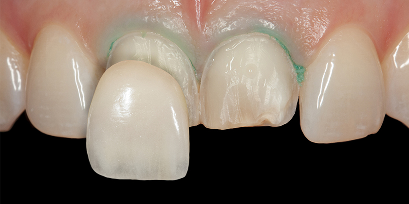 Porcelain Veneers