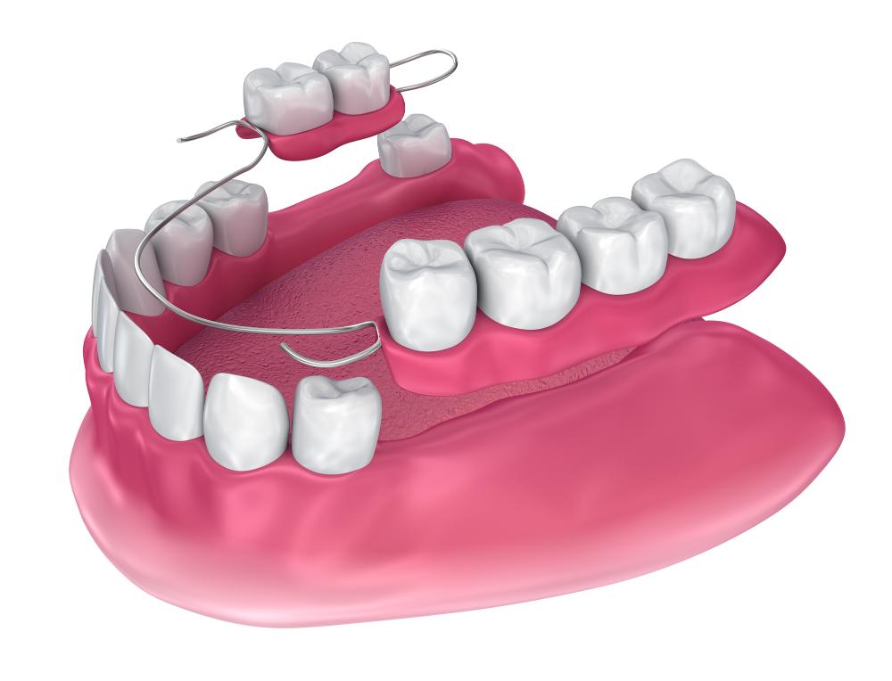 Partial Dentures For Back Teeth: What You Need To Know