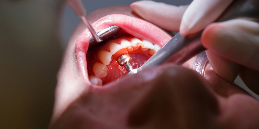 Pay Attention To These Signs Of Periodontal Disease