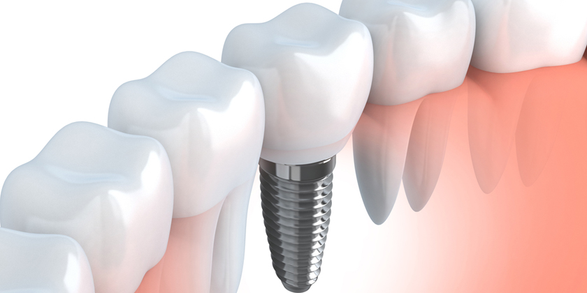Planning To Get A Single Tooth Dental Implant?