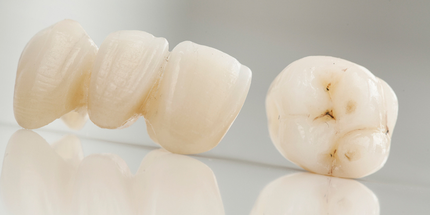 Porcelain Veneer Maintenance 101