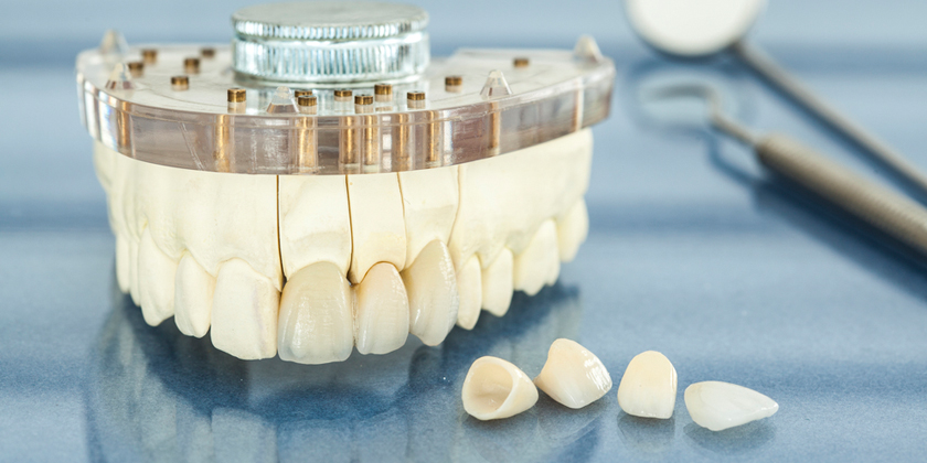 Porcelain Veneers misconceptions