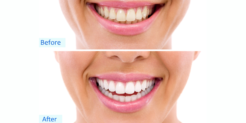teeth whitening treatment