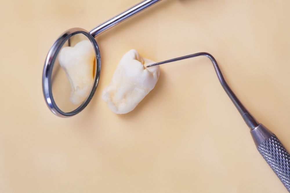 Preparing For Wisdom Tooth Extraction: What You Can Expect