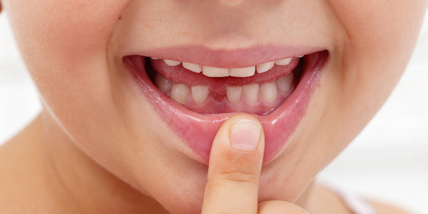 Preparing Your Child For a Tooth Extraction