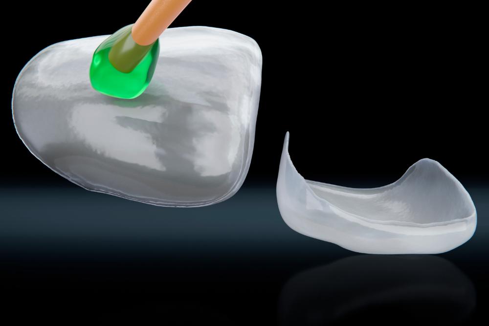 Prepping Teeth For Veneers: A Step-By-Step Guide