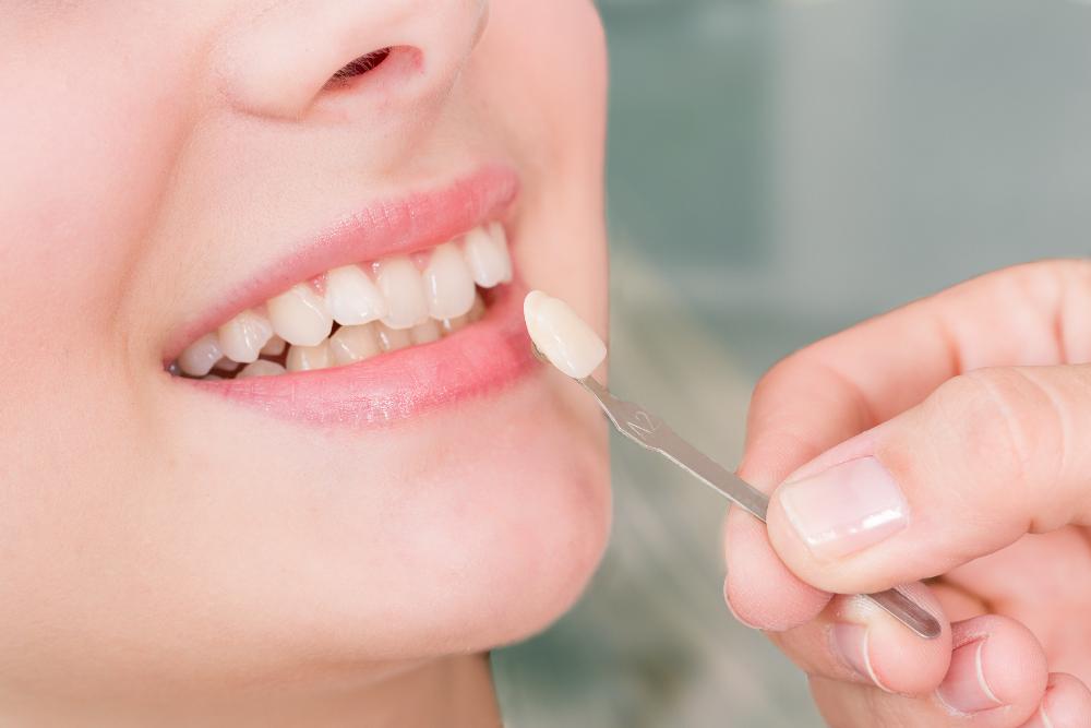 Pros And Cons Of Choosing Dental Veneers