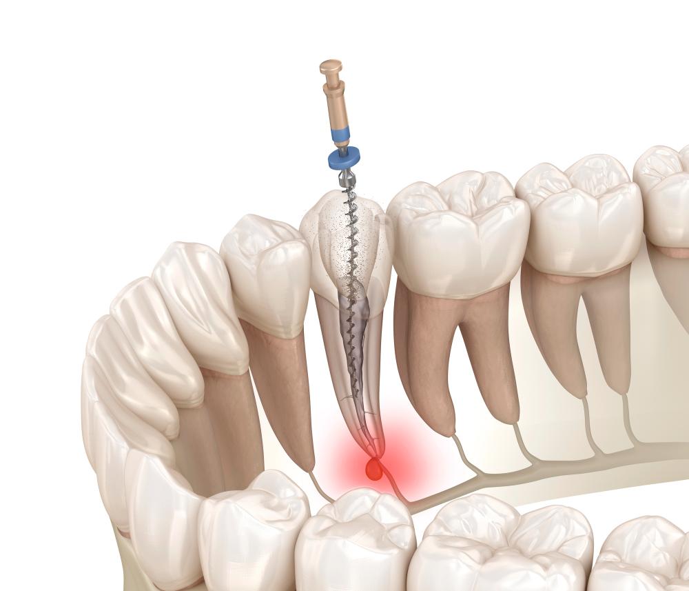 pulpotomy vs. root canal