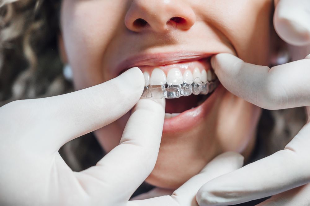 Reasons To Choose Invisalign Over Regular Braces