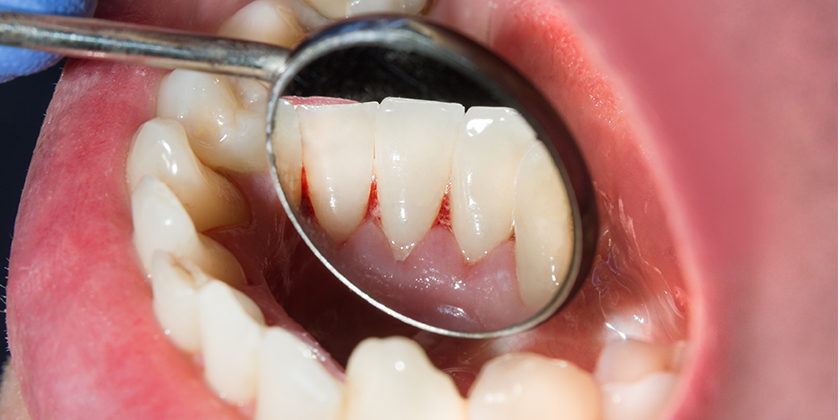 Risk Factors for Periodontal Disease