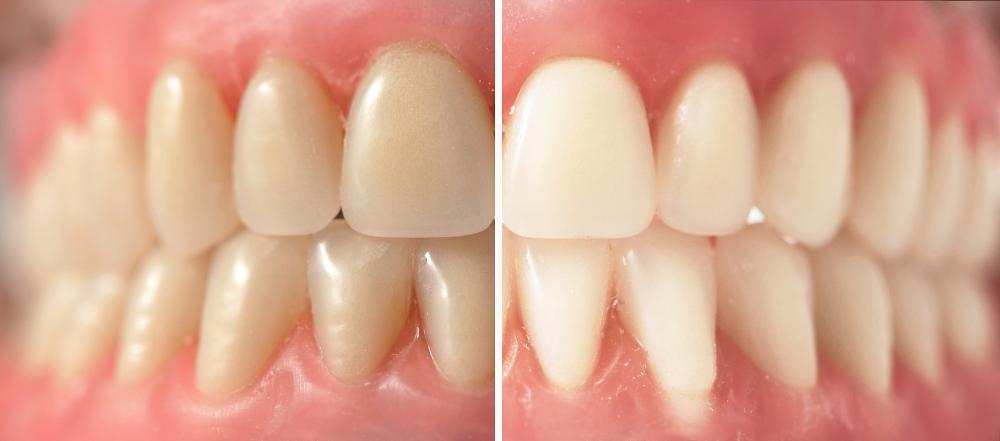 Say Goodbye To Stains: How To Whiten Dentures Effectively
