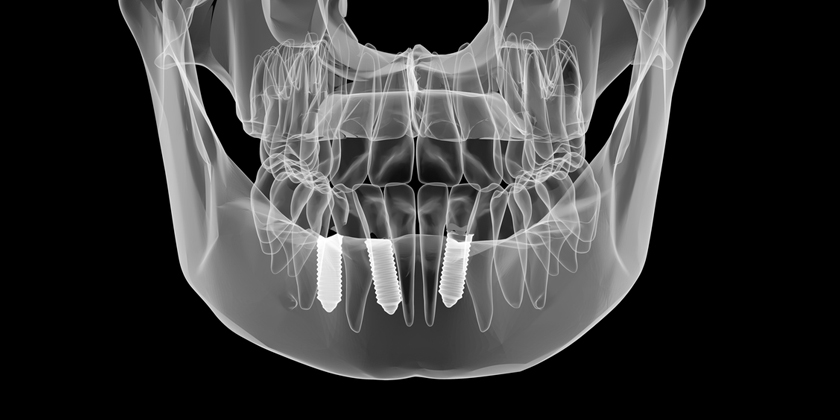 dental implants