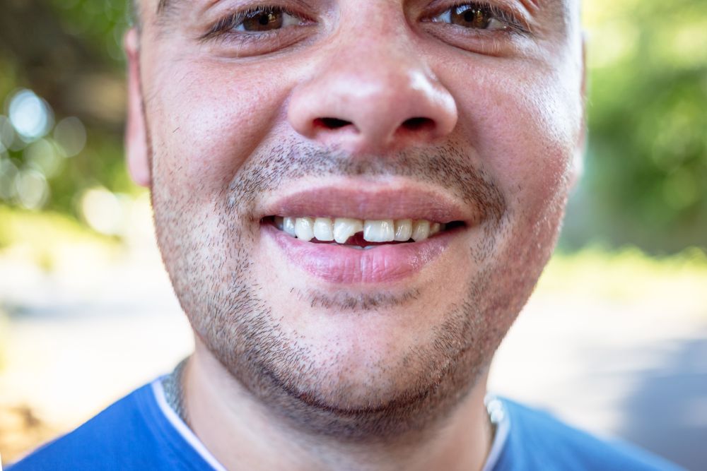 Should You Care About That Chipped Tooth?