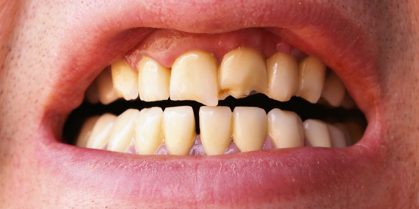 Broken Chipped Tooth