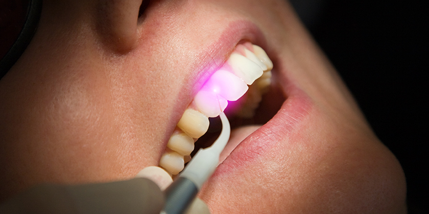 Should You Try Laser Teeth Whitening?