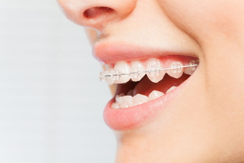 How A Smile Makeover May Boost Your Political Career