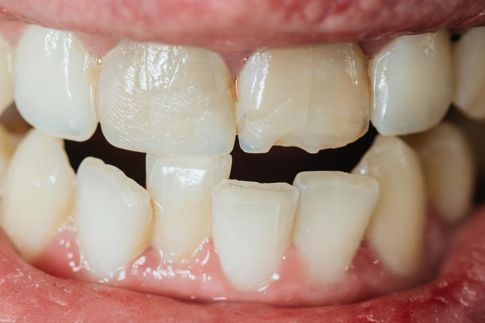 Solutions For A Chipped Tooth: Removal Or Correction?