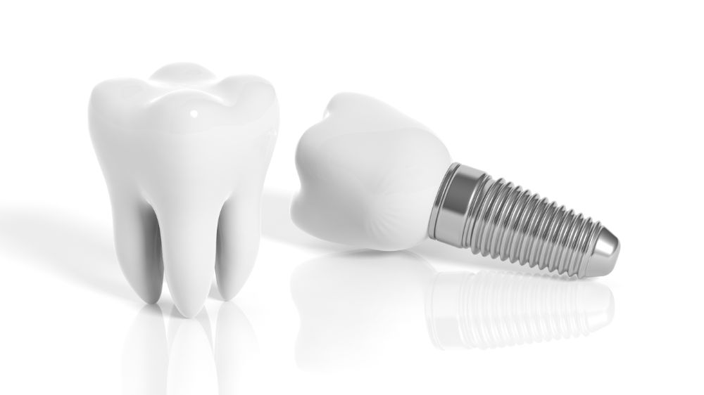 Step By Step Guide To Getting A Dental Implant