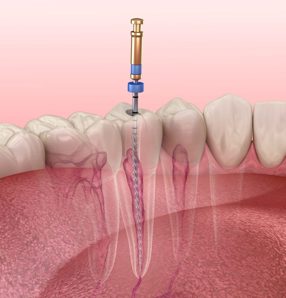 root canal procedure