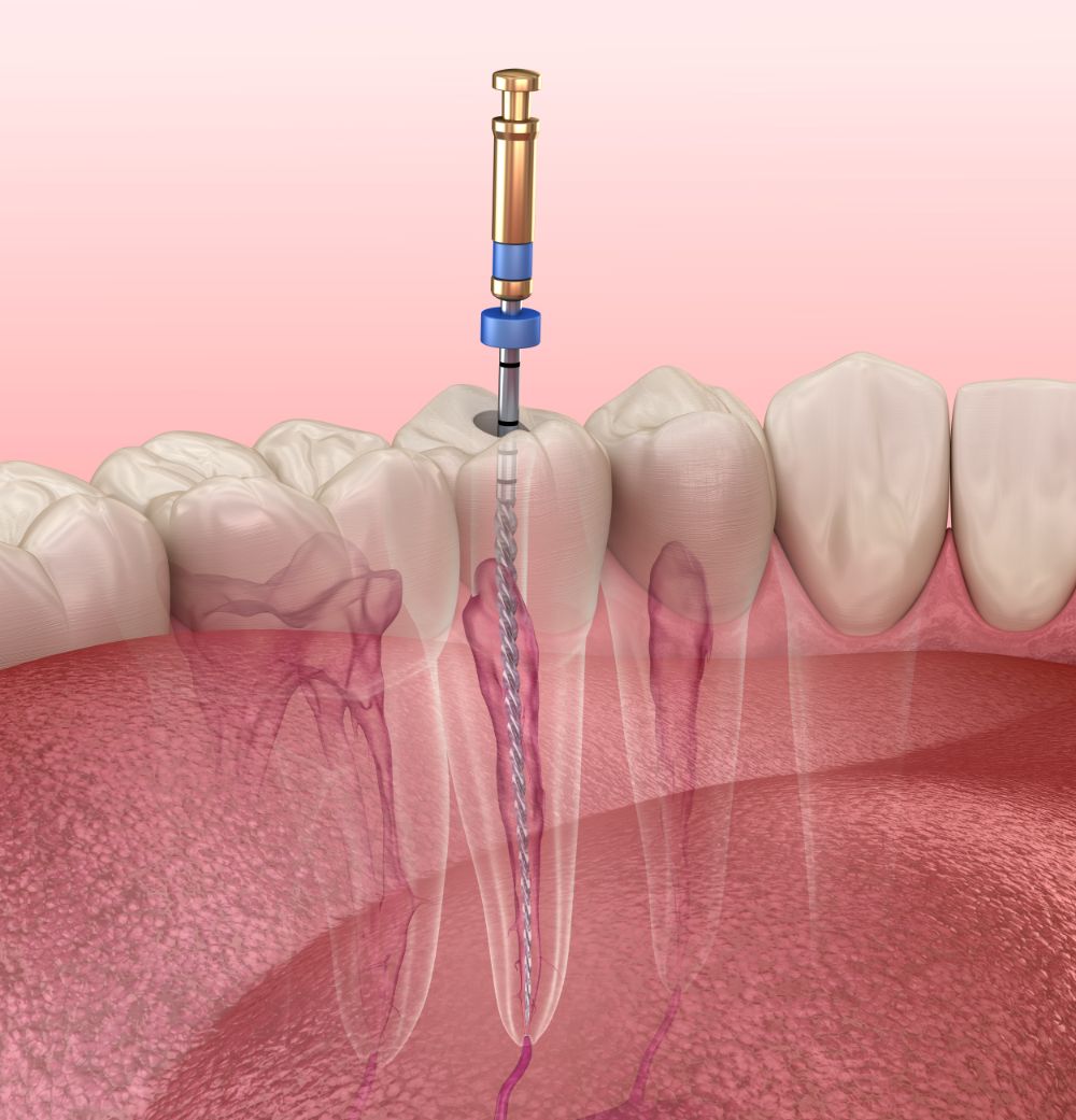 Step-By-Step: The Root Canal Procedure Explained