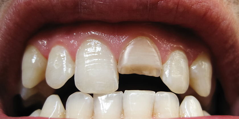 Steps To Take For A Broken Veneer