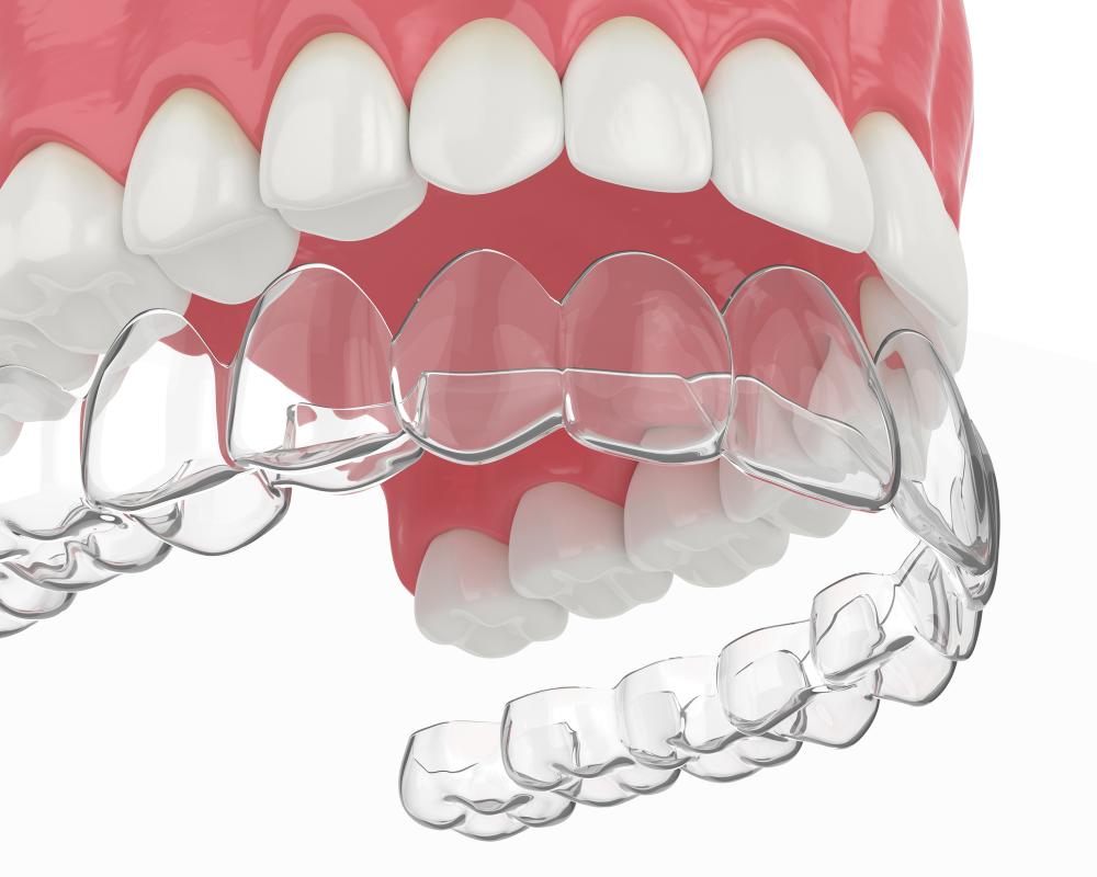 SureSmile Vs. Invisalign: Which Is More Effective?