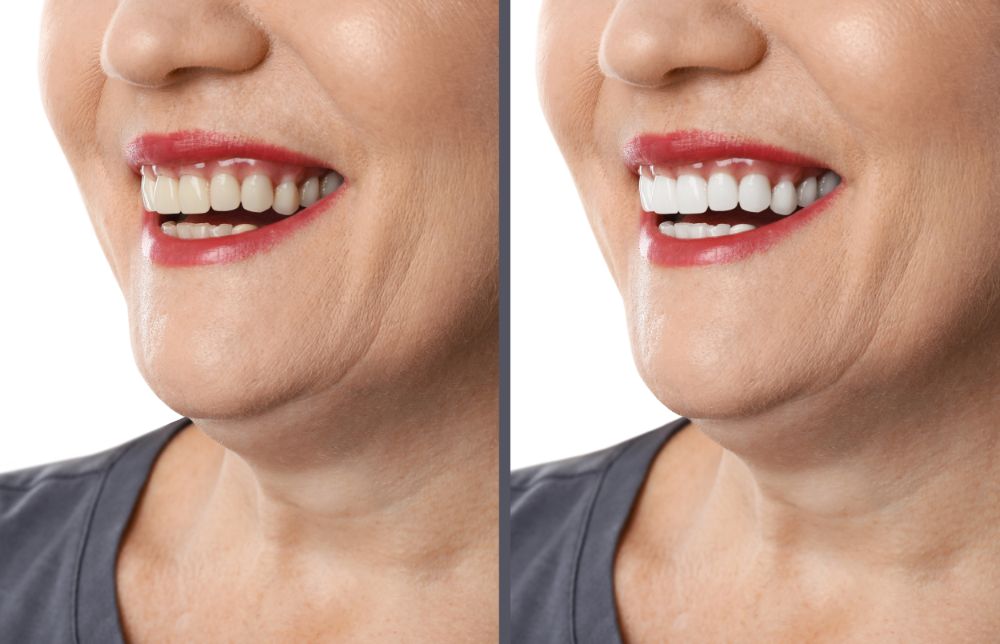 Taking Care Of Your Newly Whitened Teeth