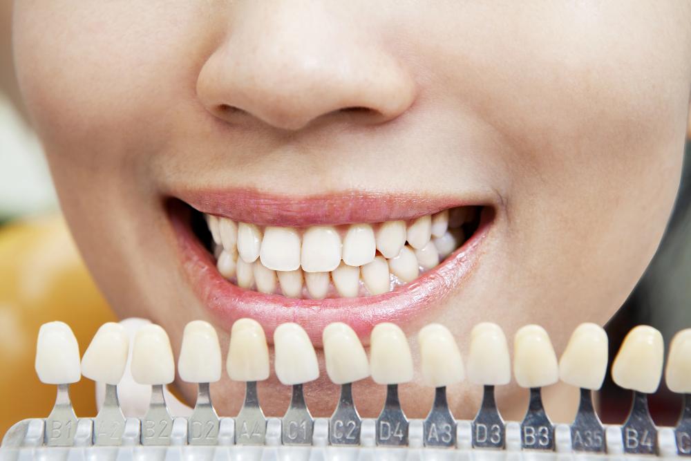 Teeth Whitening For Veneers: Is It Necessary?