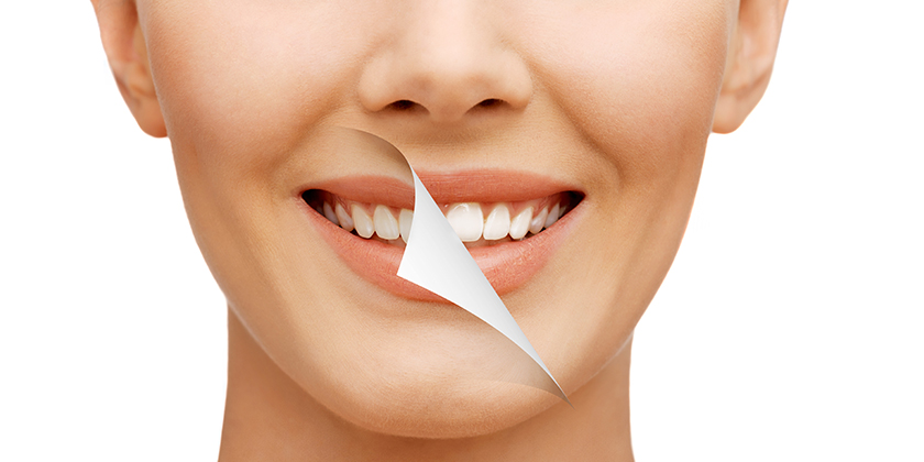 Teeth Whitening Questions You May Have