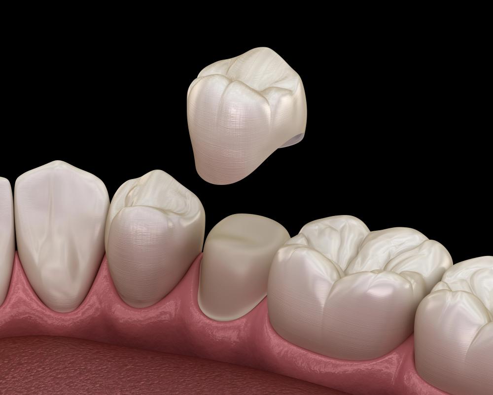 The Cost Comparison Between Dental Crowns And Dental Veneers