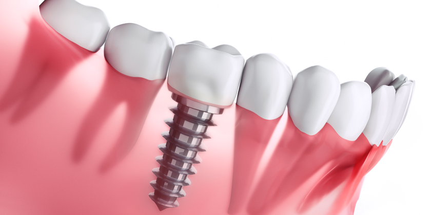 Dental Implant
