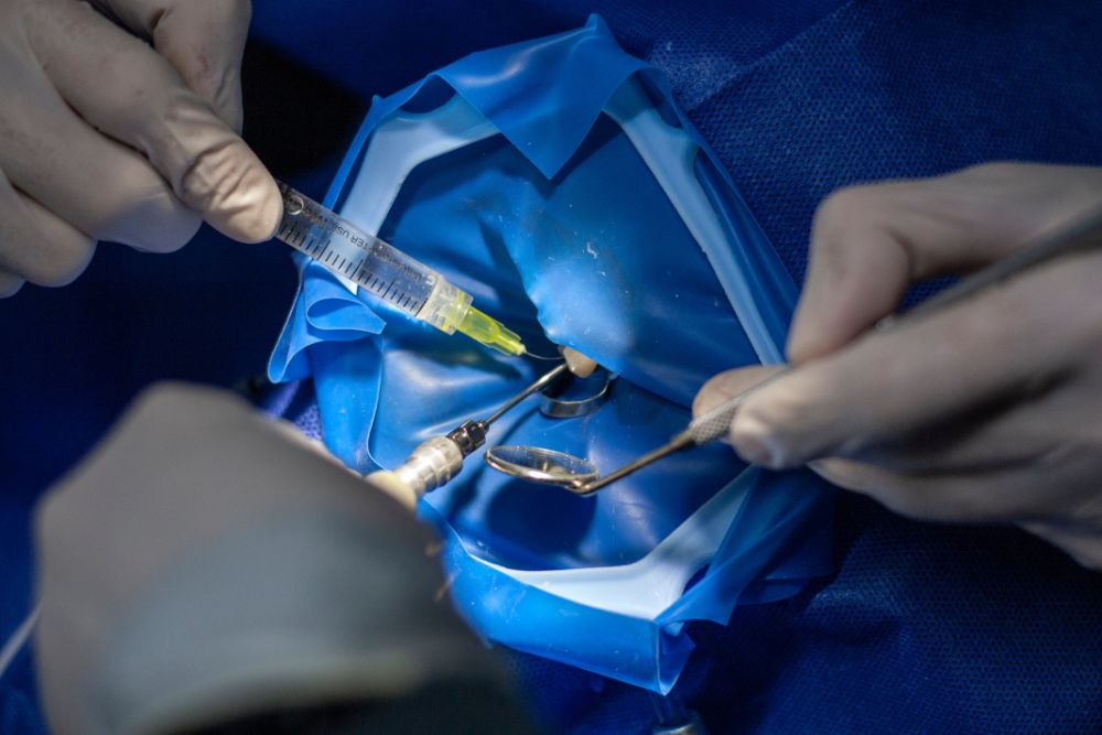 The Importance Of Root Canal Treatment After Veneers