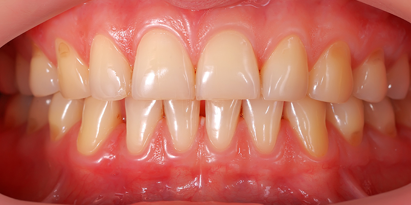 The In’s And Out’s Of Cosmetic Gum Surgery