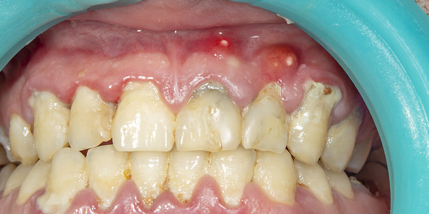 The Progression of Periodontal Disease