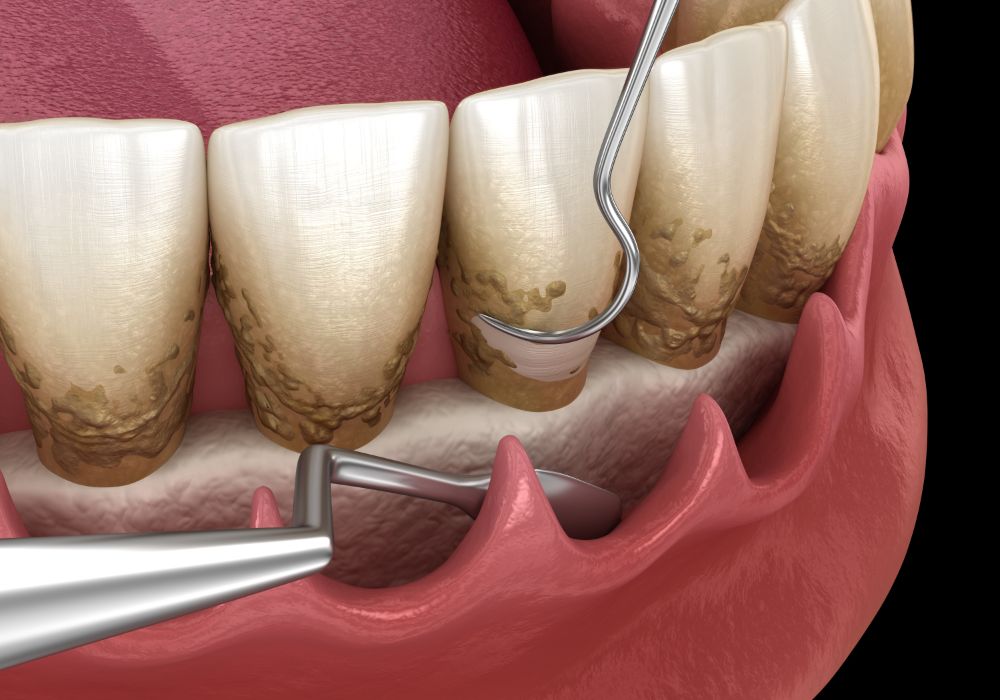 The Progressive Stages Of Periodontal Disease