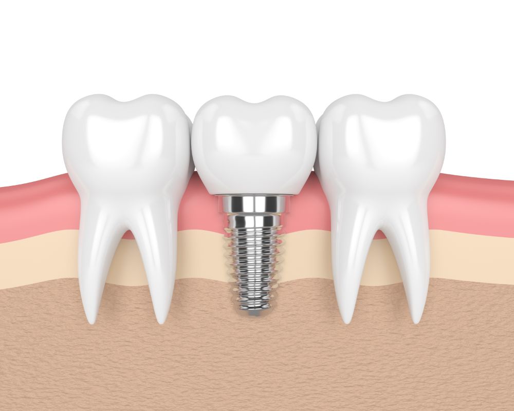 The Role Of Dental Implant Abutment For Successful Result